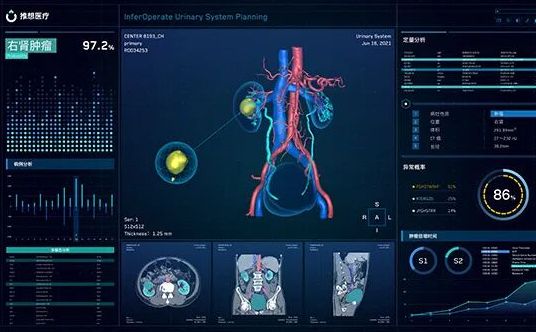 全球首个！推想医疗旗下外科手术规划软件在中美欧英四大关键市场均获批上市